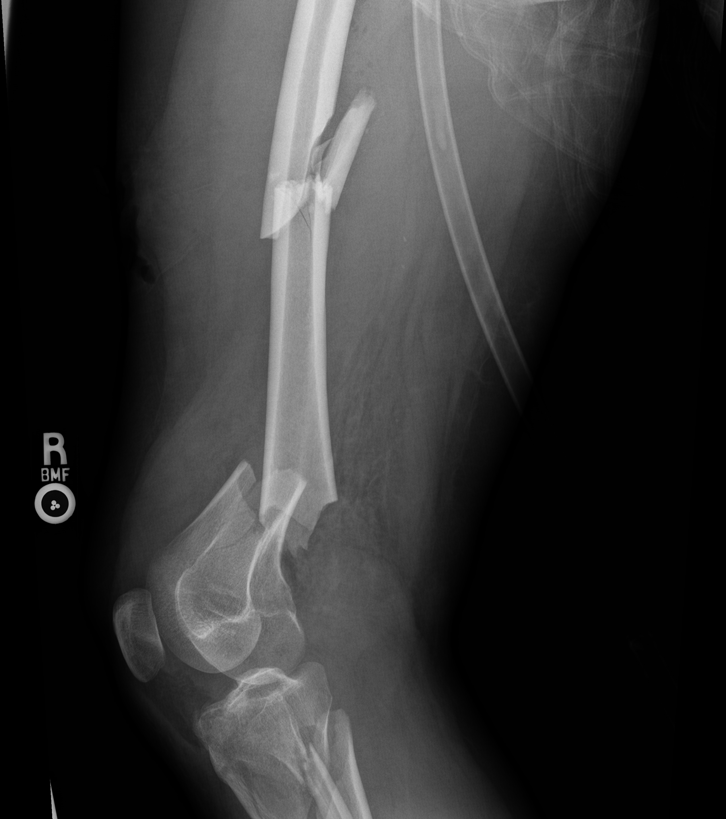 X-ray of a broken leg with surgical pins and hardware, showing bones and joints, viewed from the side.