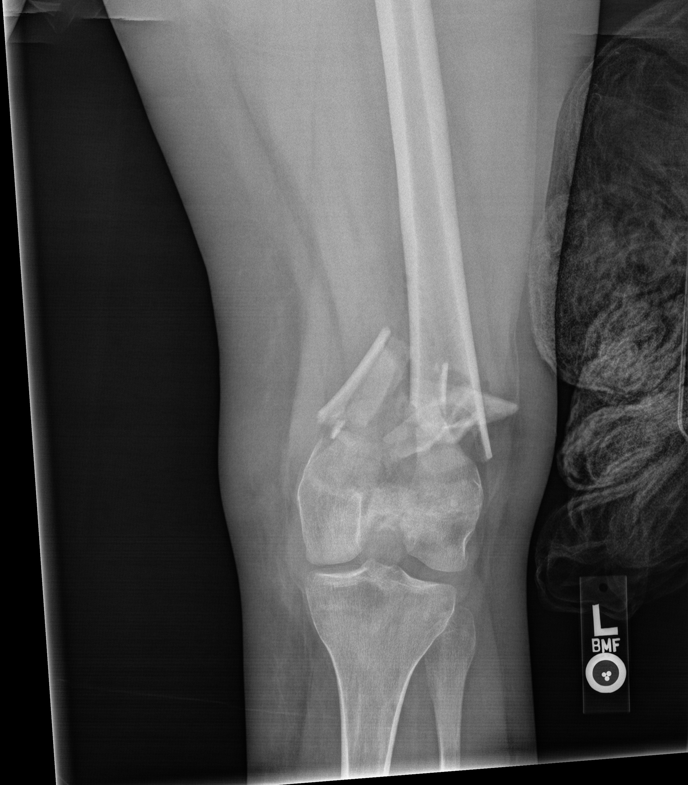 X-ray of a knee joint showing bones and surrounding tissue, with a metal rod inserted into the leg.