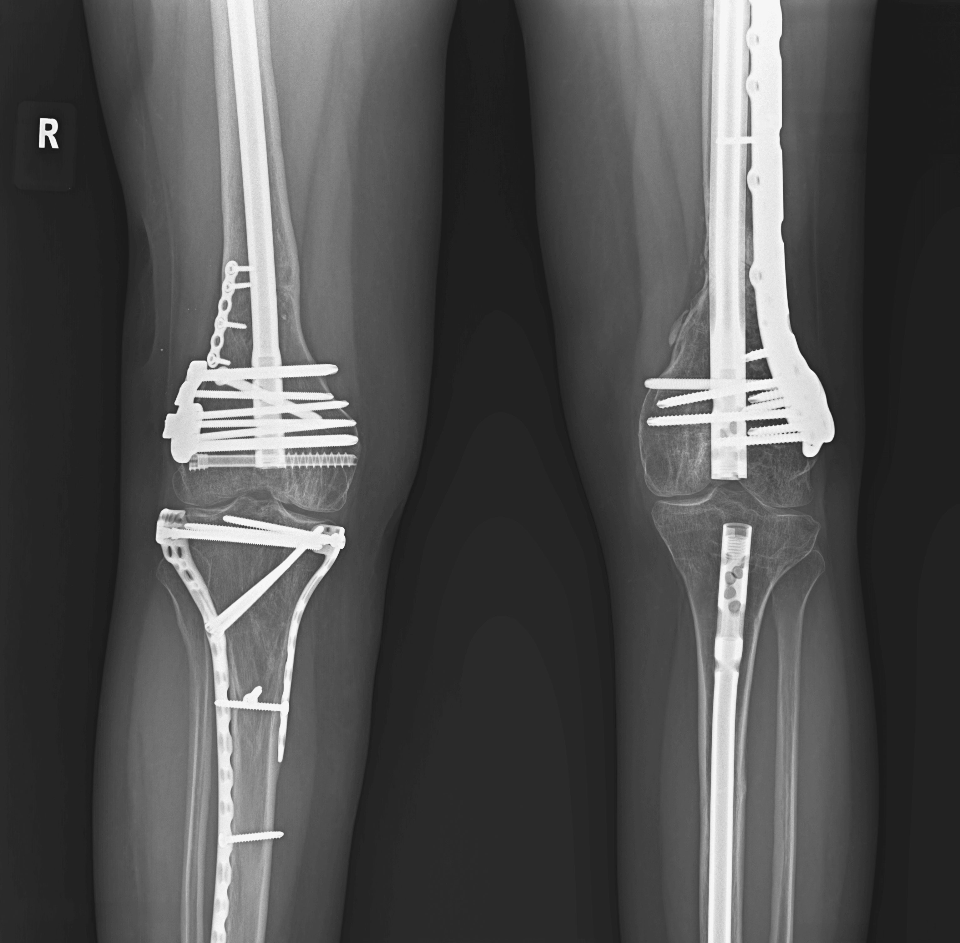 X-ray of right knee showing metal hardware and surgical fixation devices, with visible bones and joints.
