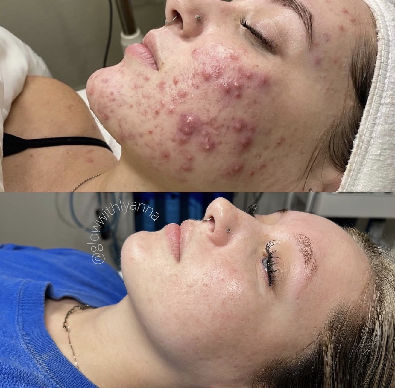 Side view of a woman before and after acne treatment, showing clear skin in the second image.